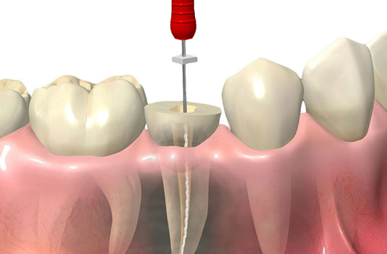 Endodontia em Santos