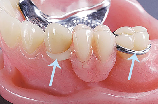 Prótese dentária em Santos